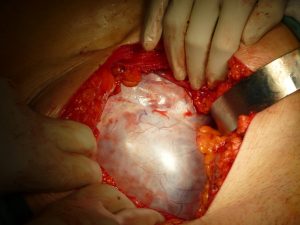 Mucinous Ovarian Cyst 1