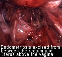 endometriosis_clip_image002