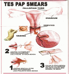 Test-Pap-smear-kanker-serviks