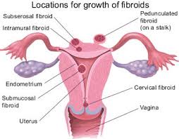 fibroid 1
