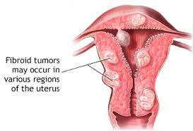 fibroid 3